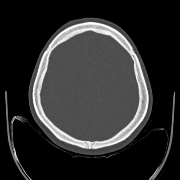 Calvarial osteoma (Radiopaedia 36520-38079 Axial bone window 80).jpg