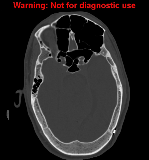 File:Calvarial thickening from chronic shunting (Radiopaedia 60079-67637 Axial bone window 68).jpg