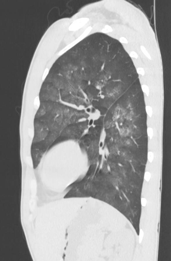 Cannabis-induced diffuse alveolar hemorrhage (Radiopaedia 89834-106946 Sagittal lung window 101).jpg