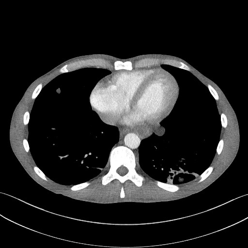 Cannonball metastases - testicular choriocarcinoma (Radiopaedia 84510-99891 B 80).jpg