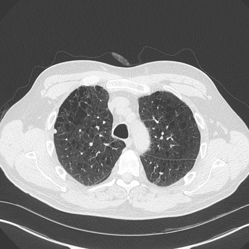 Caplan syndrome (Radiopaedia 56667-63530 Axial lung window 60).jpg