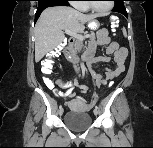 Carcinoid tumor - terminal ileum (Radiopaedia 60931-68739 B 37).jpg