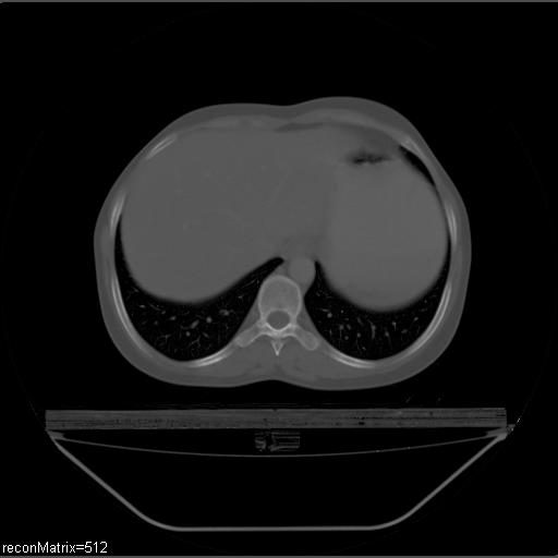 File:Carcinoma of esophagus (Radiopaedia 27356-27550 Axial bone window 8).jpg