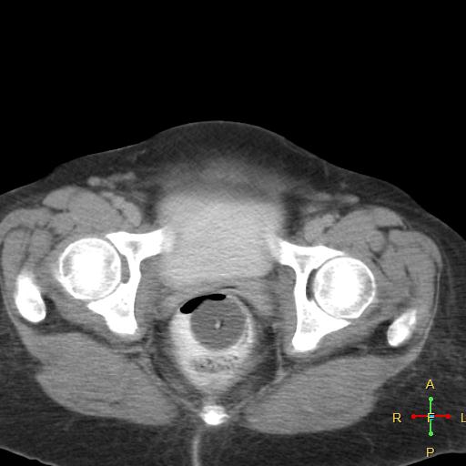 File:Carcinoma of sigmoid colon (Radiopaedia 23071-23100 C+ delayed 27).jpg