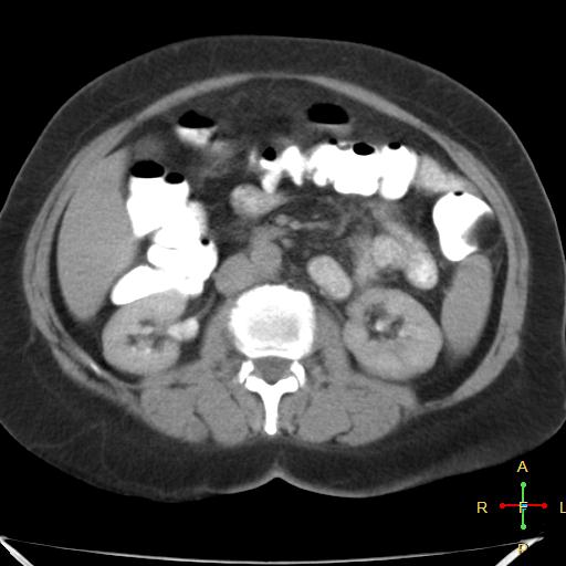 File:Carcinoma of sigmoid colon (Radiopaedia 23071-23100 C+ delayed 9).jpg