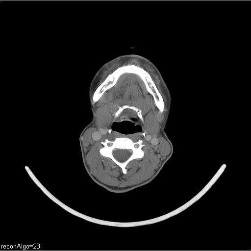 Carcinoma of the maxillary antrum (Radiopaedia 53805-59888 Axial C+ delayed 28).jpg