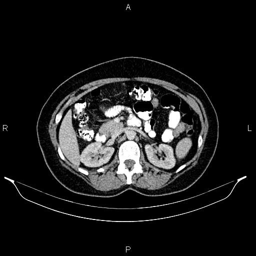 Carcinoma of uterine cervix (Radiopaedia 85861-101700 A 42).jpg