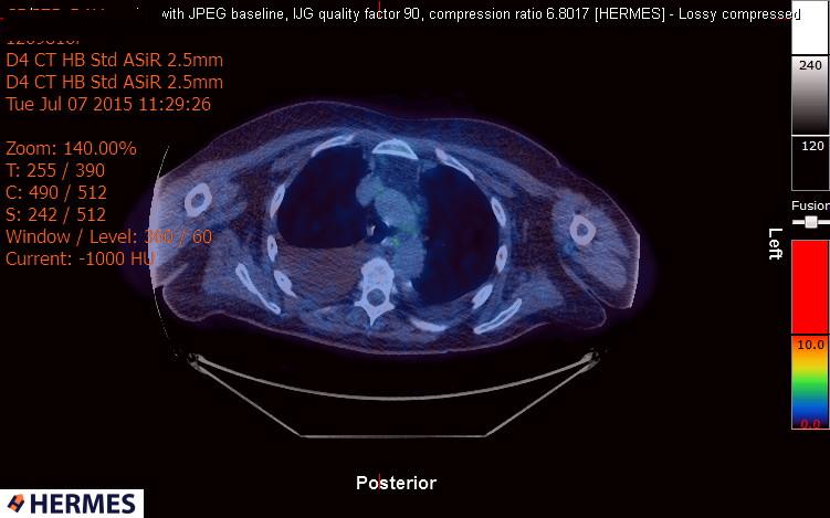 File:Cardiac lymphoma (Radiopaedia 38690-40871 Integrated PET-CT 3).jpg