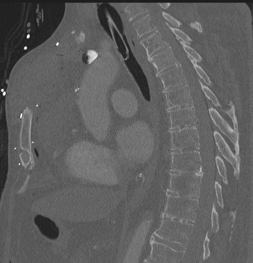 File:Cardiac trauma (Radiopaedia 32874-33858 Sagittal bone window 40).jpg