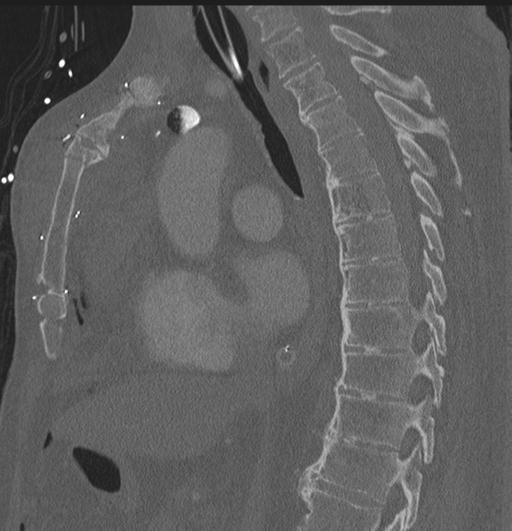 Cardiac trauma (Radiopaedia 32874-33858 Sagittal bone window 45).jpg