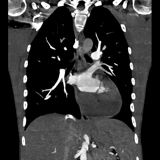 Cardiac tumor - undifferentiated pleomorphic sarcoma (Radiopaedia 45844-50134 Coronal non-contrast 39).png