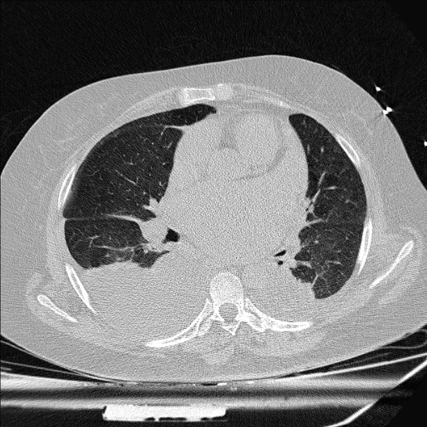 Cardiogenic pulmonary edema (Radiopaedia 29213-29609 Axial lung window 50).jpg