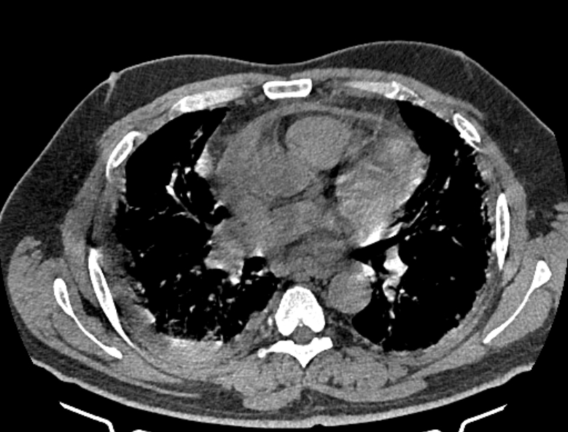 Cardiogenic pulmonary edema (Radiopaedia 68180-77678 Axial non-contrast 25).jpg