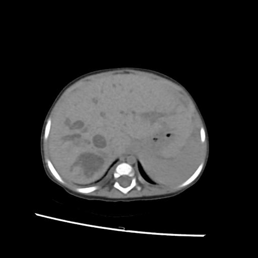 File:Caroli disease with autosomal recessive polycystic kidney disease (ARPKD) (Radiopaedia 89651-106703 Axial non-contrast 9).jpg