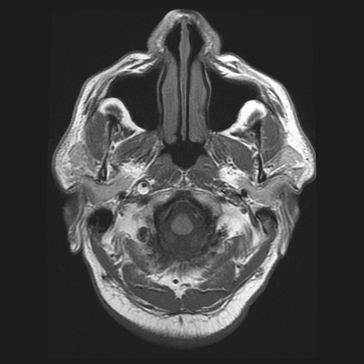 File:Carotid arterial dissection with acute cerebral infarction (Radiopaedia 26636-26784 Axial T1 2).jpg