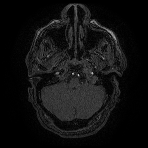 Carotid arterial dissection with acute cerebral infarction (Radiopaedia 26636-26784 MRA 146).jpg