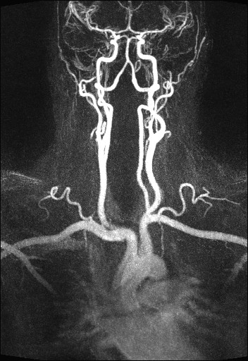 File:Carotid artery dissection (Radiopaedia 28441-28689 MIP Carotids MRA 1).jpg