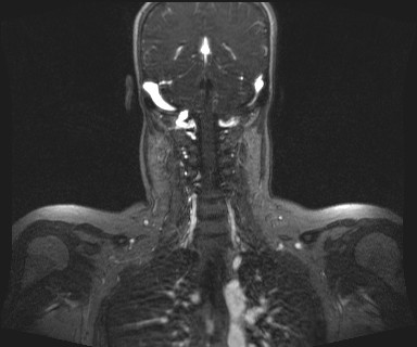 Carotid body tumor (Radiopaedia 12777-12912 MRA 50).jpg