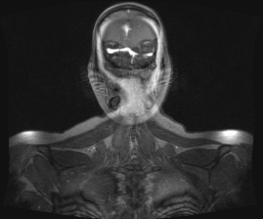 Carotid body tumor (Radiopaedia 12777-12912 MRA 78).jpg