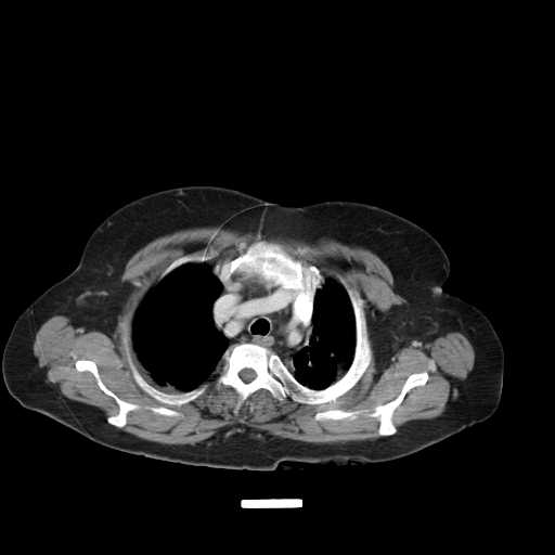 File:Carotid body tumor (Radiopaedia 21021-20948 A 28).jpg