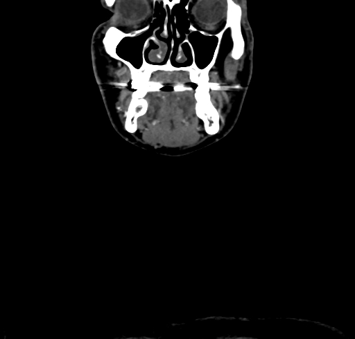 File:Carotid body tumor (Radiopaedia 83615-98727 B 18).jpg