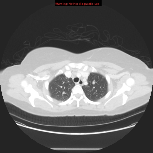 Carotid body tumor with lung metastases (Radiopaedia 9301-48390 Axial lung window 19).jpg