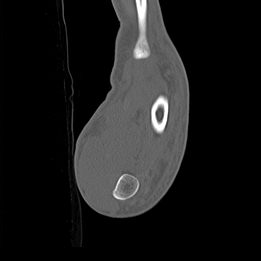 File:Carpo-metacarpal fracture-dislocations with hamatum split fracture (Radiopaedia 18482-18343 Sagittal bone window 30).jpg