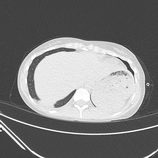 Catamenial pneumothorax (Radiopaedia 27946-28197 lung window 137).jpg