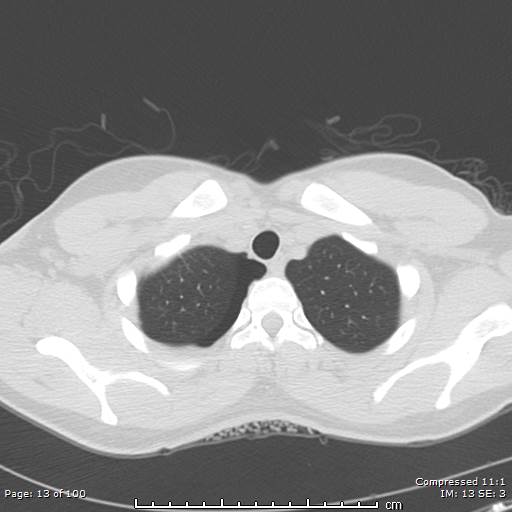 Catamenial pneumothorax (Radiopaedia 54382-60600 Axial non-contrast 13).jpg