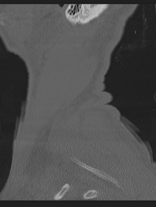 Cavernoma of cervical cord (Radiopaedia 50838-56346 Sagittal bone window 78).png
