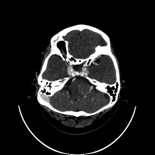 Cavernoma with developmental venous anomaly (Radiopaedia 22470-22506 C 29).jpg