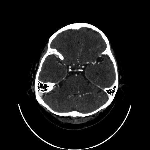 Cavernoma with developmental venous anomaly (Radiopaedia 22470-22506 C 41).jpg