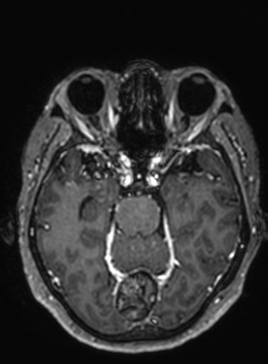 File:Cavernous hemangioma of the cerebellar falx (Radiopaedia 73025-83724 Axial T1 C+ 214).jpg