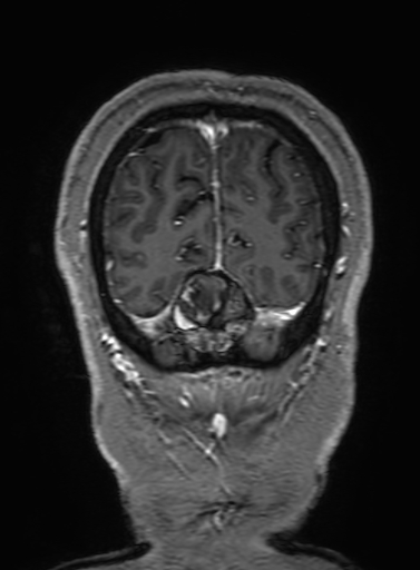 Cavernous hemangioma of the cerebellar falx (Radiopaedia 73025-83724 Coronal T1 C+ 335).jpg