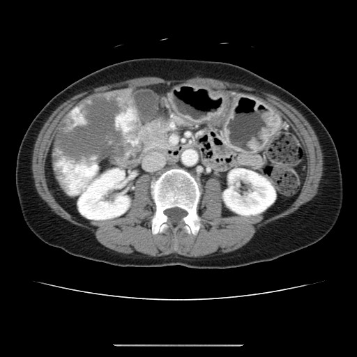 Cavernous hepatic hemangioma (Radiopaedia 75441-86667 B 52).jpg
