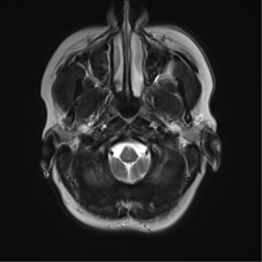 File:Cavernous malformation (cavernous angioma or cavernoma) (Radiopaedia 36675-38237 Axial T2 1).png