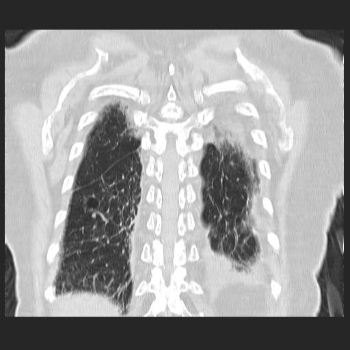 File:Cavitating pulmonary metastases (Radiopaedia 89545-106544 Coronal lung window 38).jpg