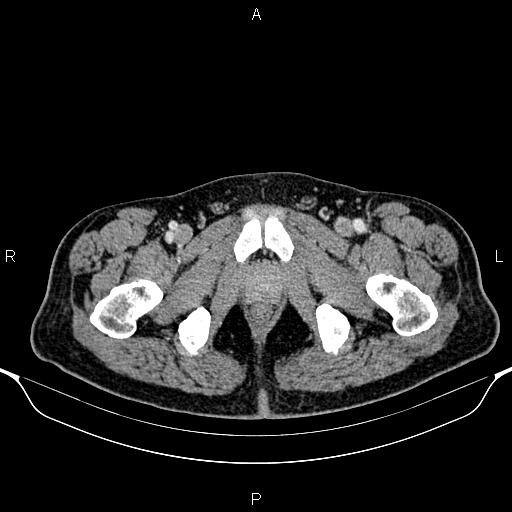 Cecal adenocarcinoma (Radiopaedia 85324-100916 B 103).jpg