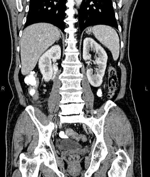 Cecal cancer with appendiceal mucocele (Radiopaedia 91080-108651 D 49).jpg