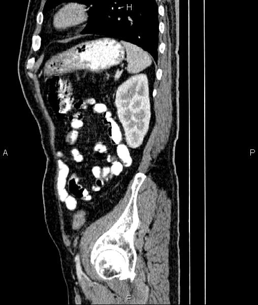 File:Cecal cancer with appendiceal mucocele (Radiopaedia 91080-108651 E 75).jpg