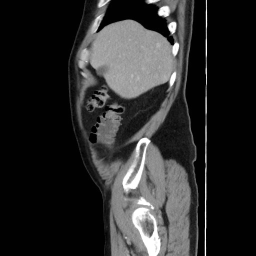 Cecal mass causing appendicitis (Radiopaedia 59207-66531 C 10).jpg
