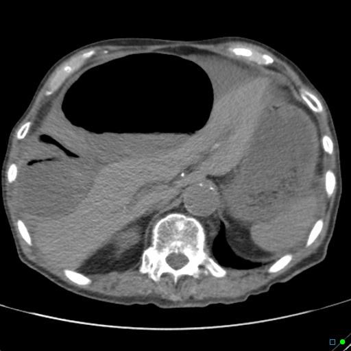 Cecal volvulus - atypical (Radiopaedia 21637-21588 non-contrast 17).jpg