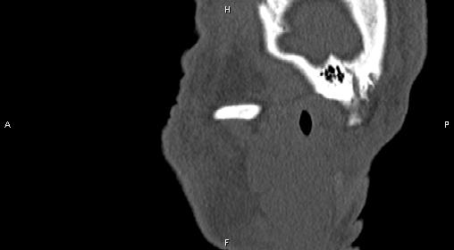 File:Central giant cell granuloma (Radiopaedia 83346-97761 Sagittal bone window 3).jpg