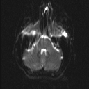 Central neurocytoma (Radiopaedia 56690-63469 Axial DWI 3).jpg