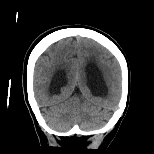 Central neurocytoma (Radiopaedia 65317-74346 Coronal non-contrast 45).png