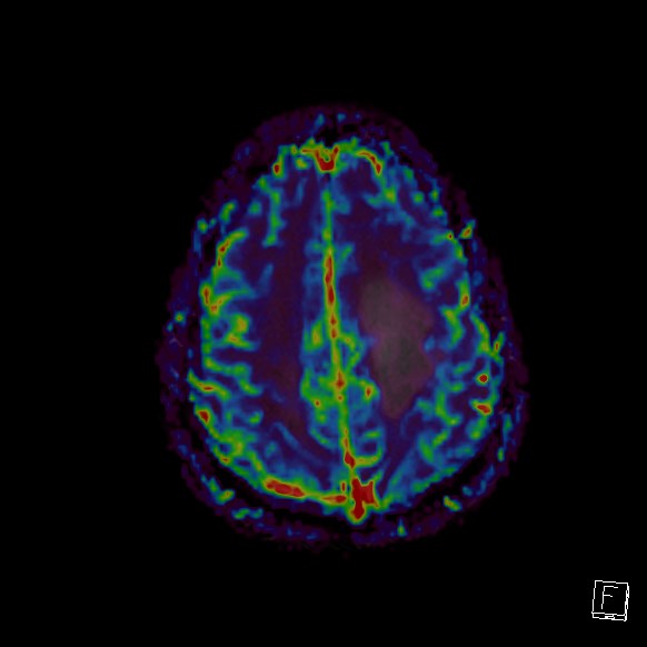 Central neurocytoma (Radiopaedia 84497-99872 Axial Perfusion 68).jpg