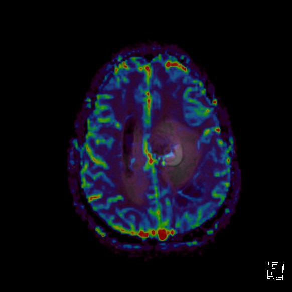 Central neurocytoma (Radiopaedia 84497-99872 Axial Perfusion 85).jpg