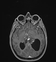 Central neurocytoma (Radiopaedia 84497-99872 Axial T1 C+ 77).jpg