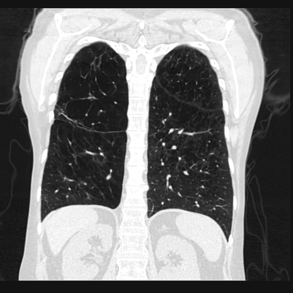 Centrilobular pulmonary emphysema (Radiopaedia 24495-24789 Coronal lung window 55).jpg