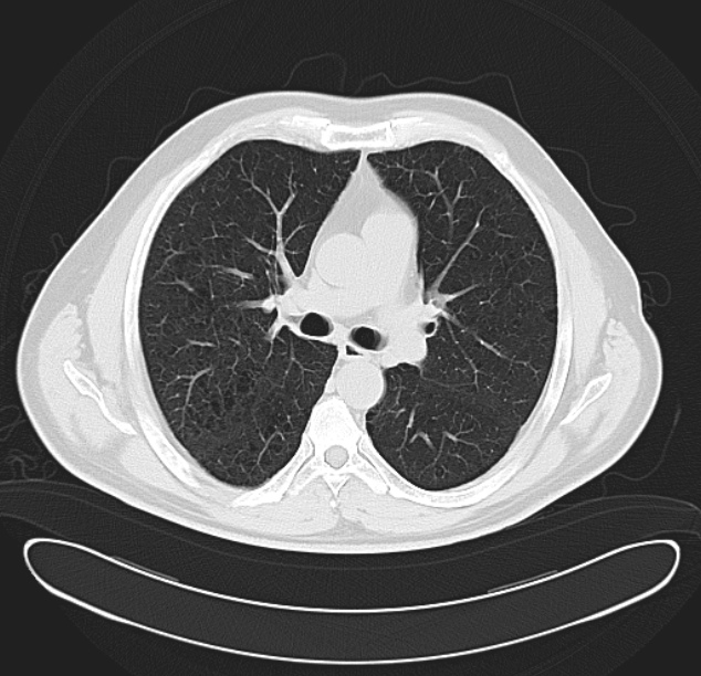 Centrilobular pulmonary emphysema (Radiopaedia 26808-26971 C 20).jpg